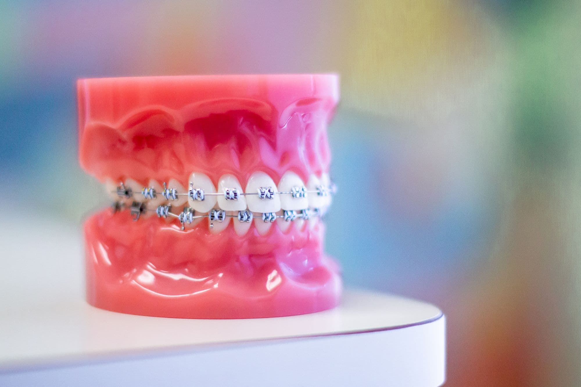 retainers after braces